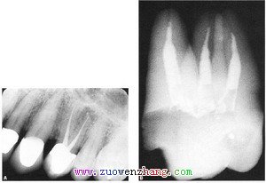 左图根管锥度连续、右图根管烧瓶样